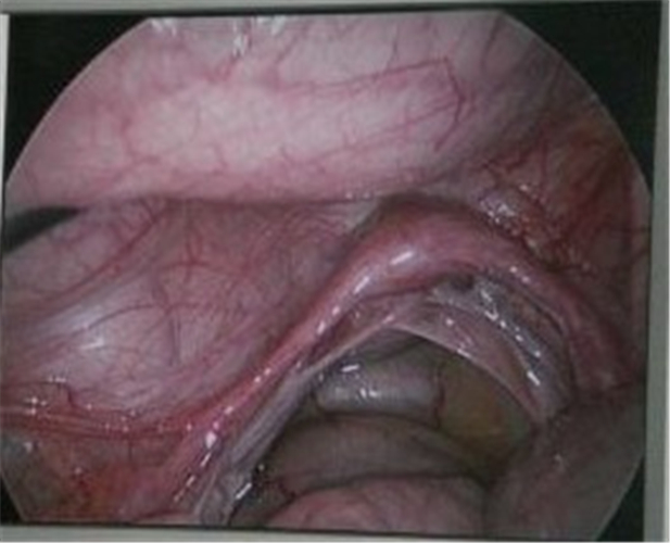 微創治療男性假兩性畸形