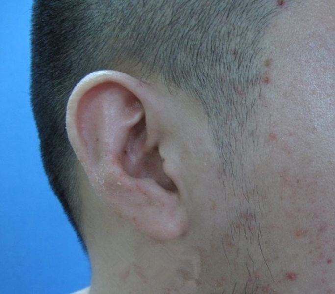 耳部異位性皮炎