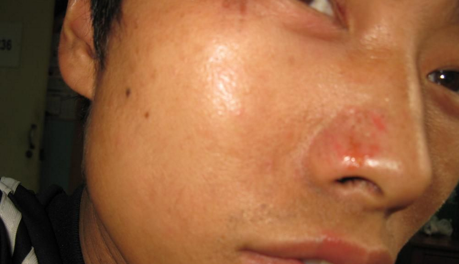 鼻子隱翅蟲皮炎