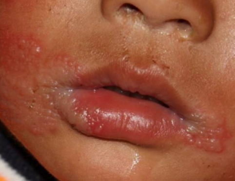 嘴唇潰瘍