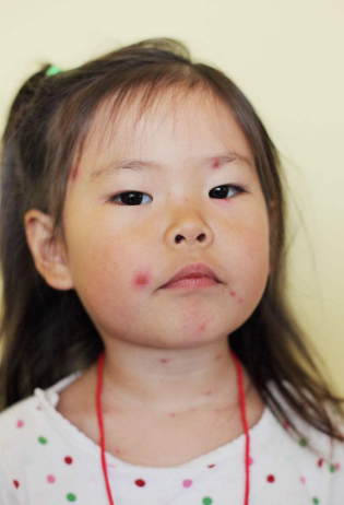 長水痘的症狀 (58) 