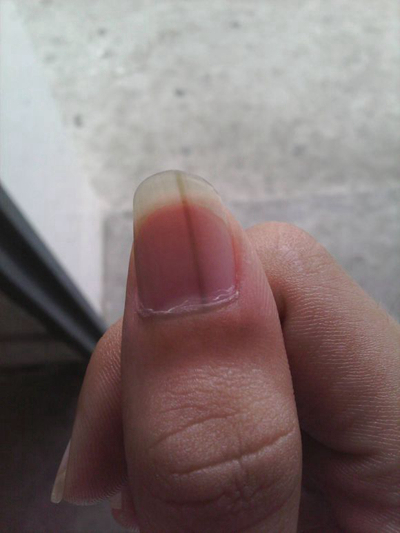 手指甲上有豎紋圖解 (36) 