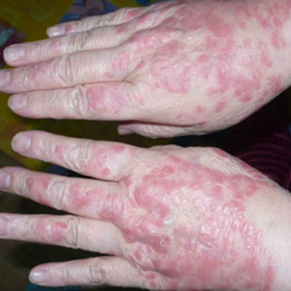 中年女性皮膚念珠菌病