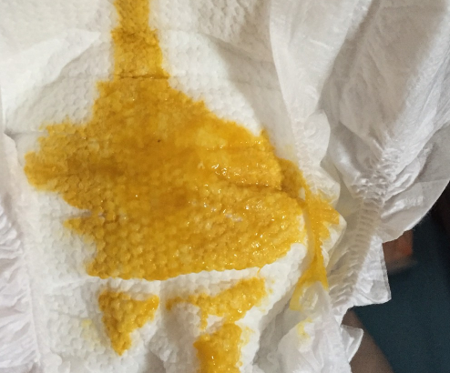 新生兒腹瀉大便