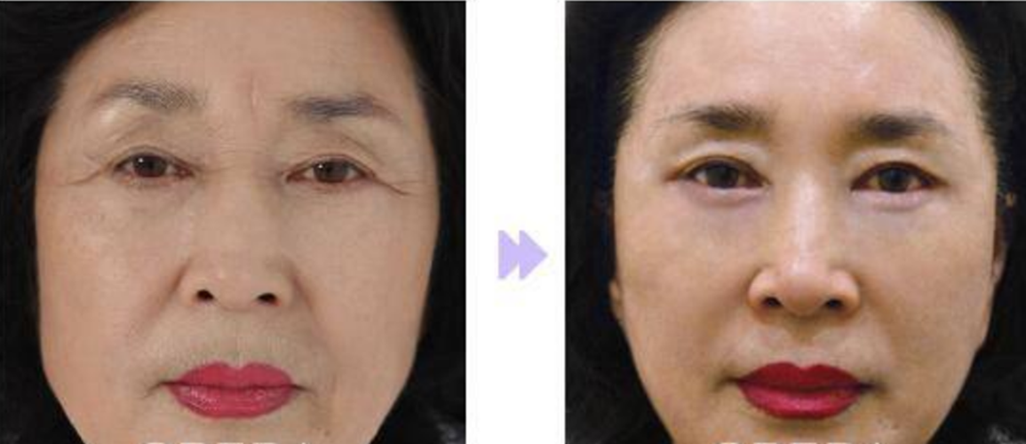 輕度的皮膚老化