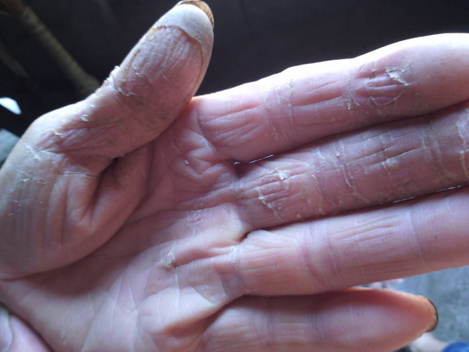 角化型手部溼疹