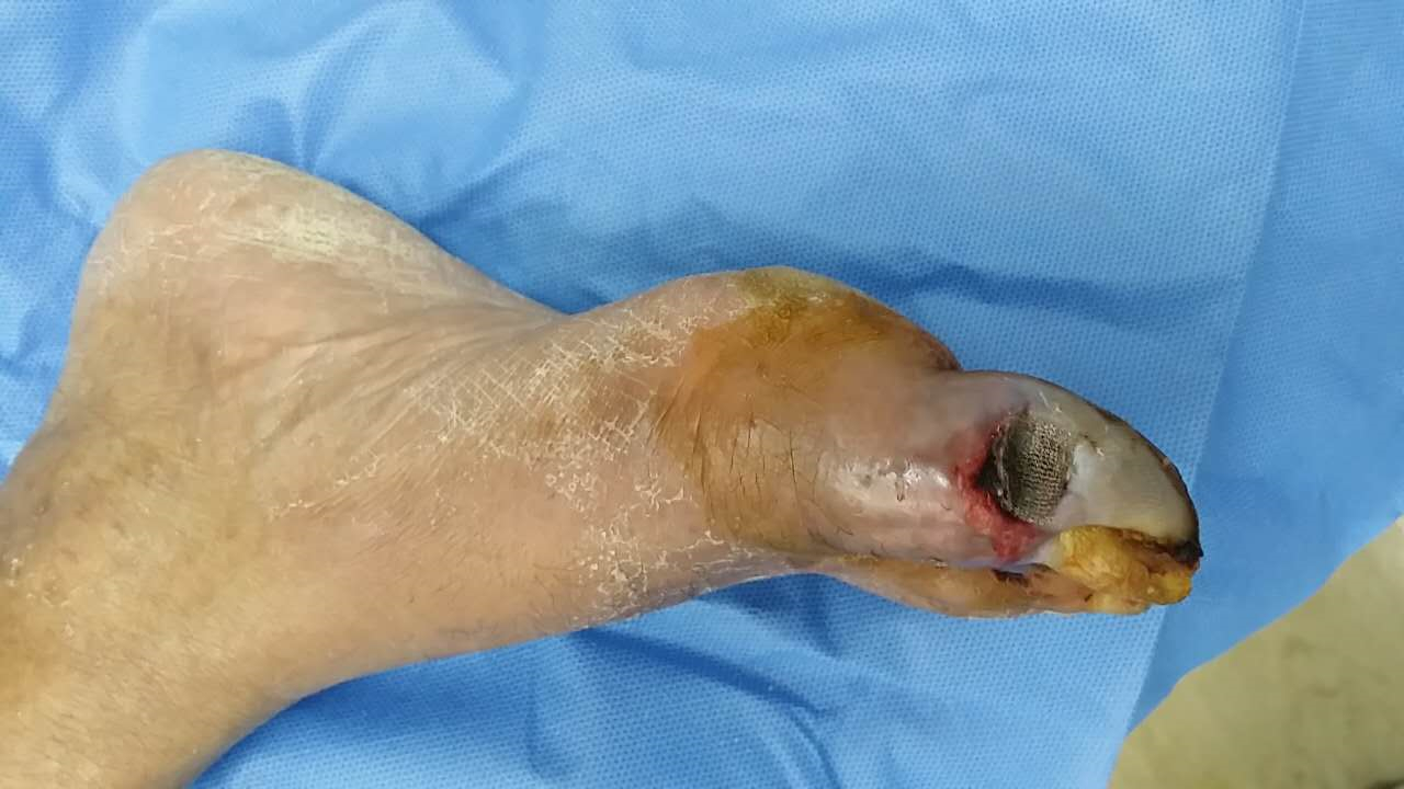 糖尿病足左腳高清