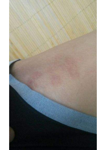 體股癬初期現象