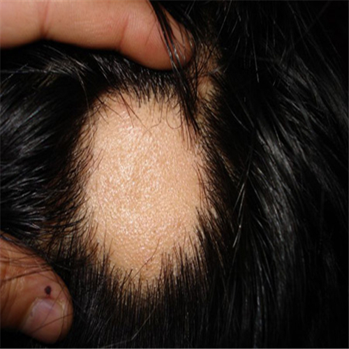 皮脂腺痣痊癒後