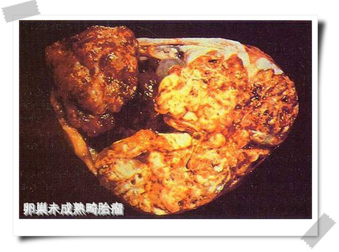 卵巢癌未成熟畸胎瘤