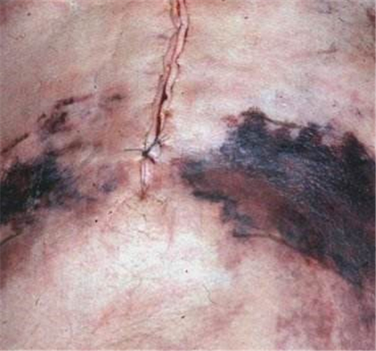 重症急性胰腺炎治療創口