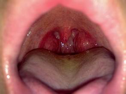 食道炎的症狀圖 