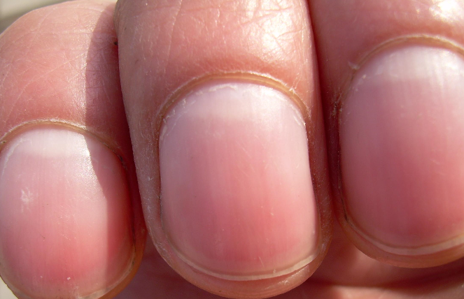 貧血指甲