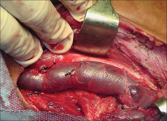 頸靜脈怒張 (36) 