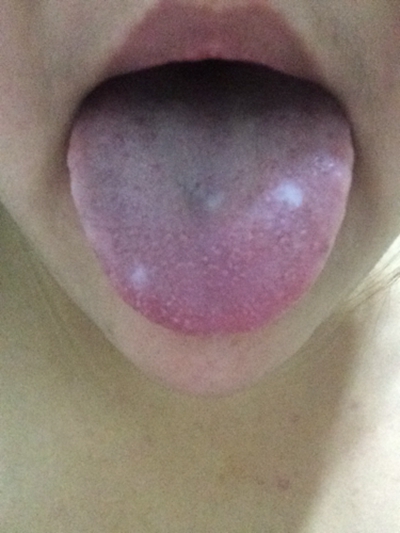 口腔念珠菌感染 (4) 