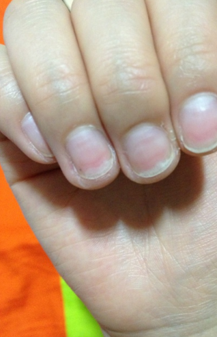貧血指甲
