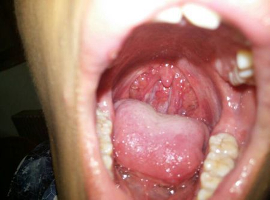 食道炎的症狀圖 (8) 