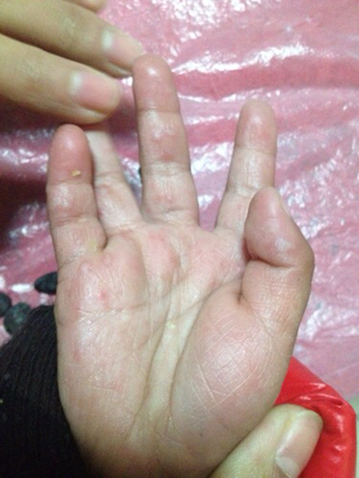 手指溼疹症狀
