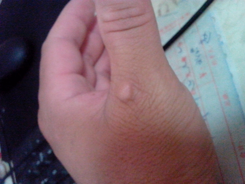 手部皮膚黃色瘤病