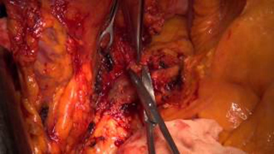 右半結腸癌的腺癌常見 臨床 特點