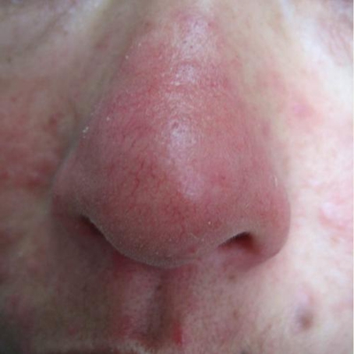 鼻子長蟎蟲症狀