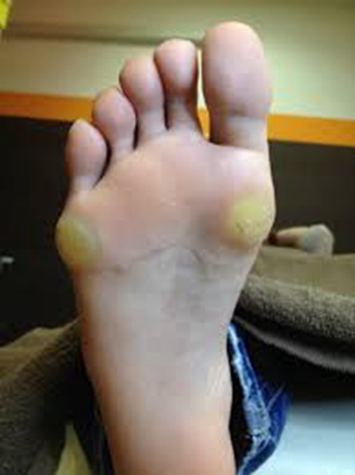 胼胝足部