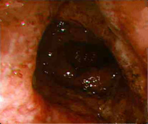 嚴重慢性結腸炎的