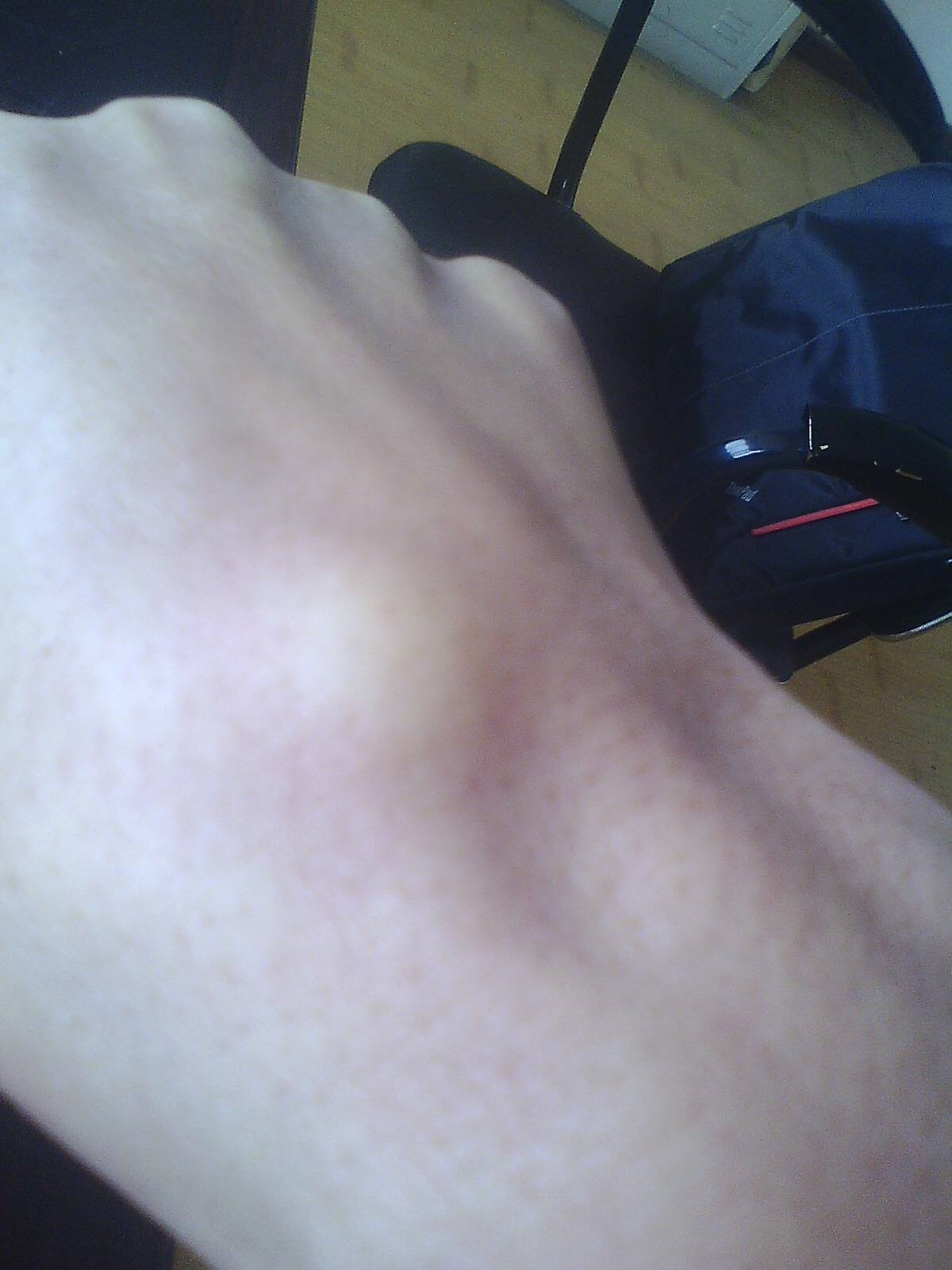 右手腕背部手腕腱鞘炎