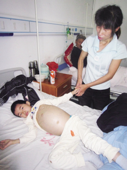 小孩肝腹水症狀