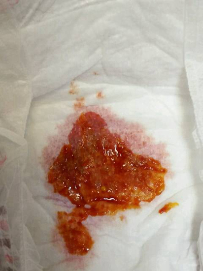 結腸癌症狀 (37) 