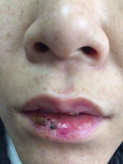 扁平苔蘚治療偏方 