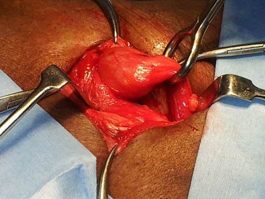 硬膜下血腫 (47) 