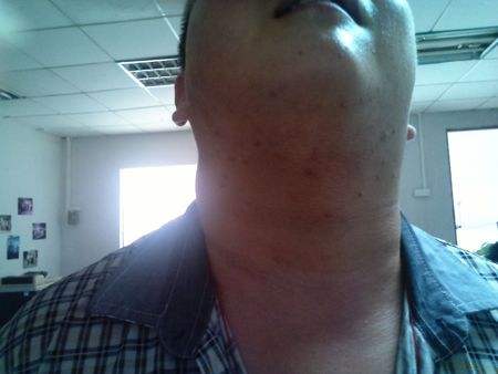 慢性淋巴結炎 (50) 