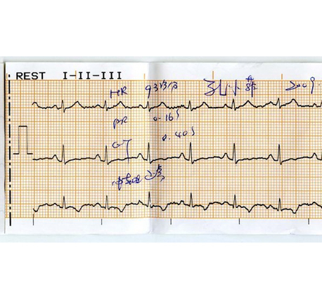 房顫心電圖特點 (41) 
