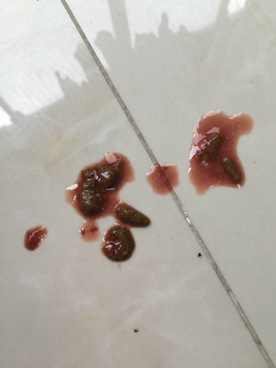 直腸癌晚期症狀 (38) 