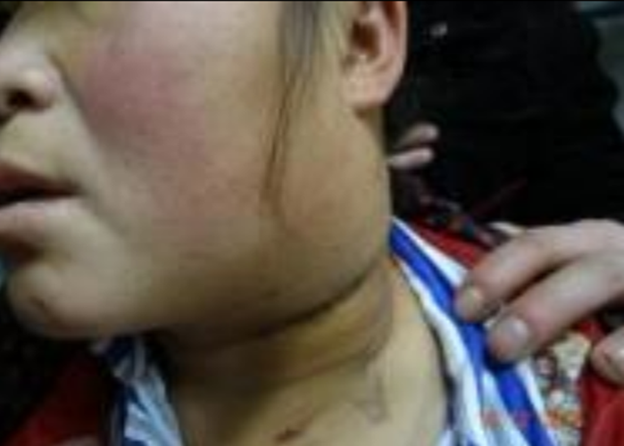 女性腋下淋巴癌早期症狀