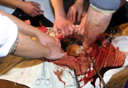 剖腹產手術 (60) 