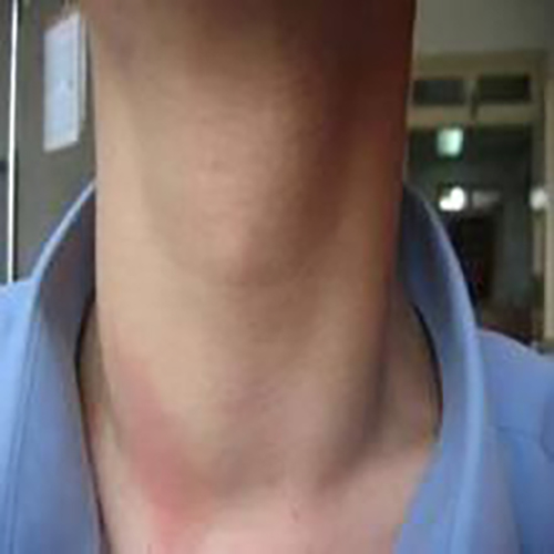 亞急性甲狀腺炎症狀