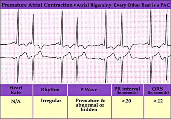 頻發房性早搏 (9) 