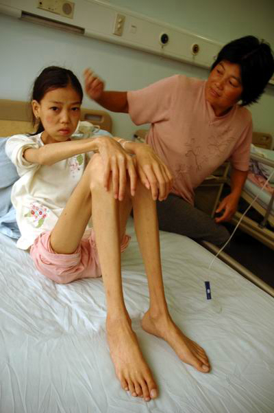 身體消瘦的原因 (76) 