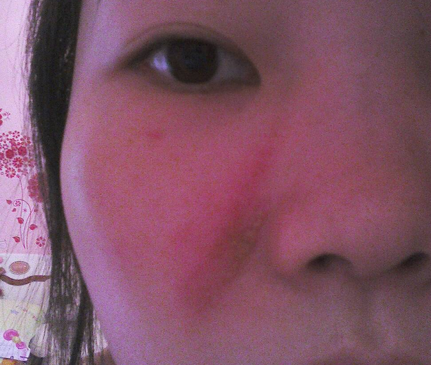 隱翅蟲皮炎臉部