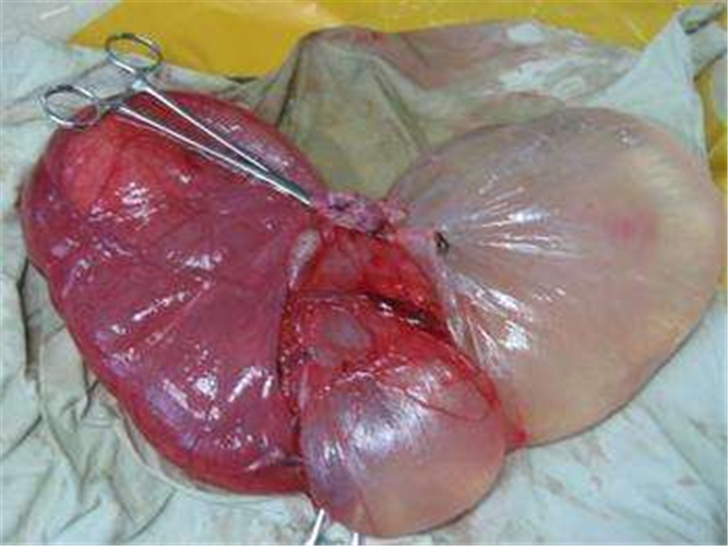 手術切除的卵巢囊腫