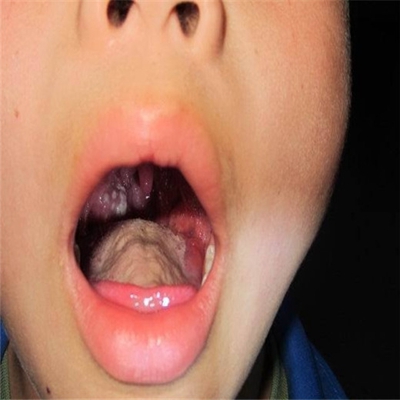 扁桃體癌圖  (58) 