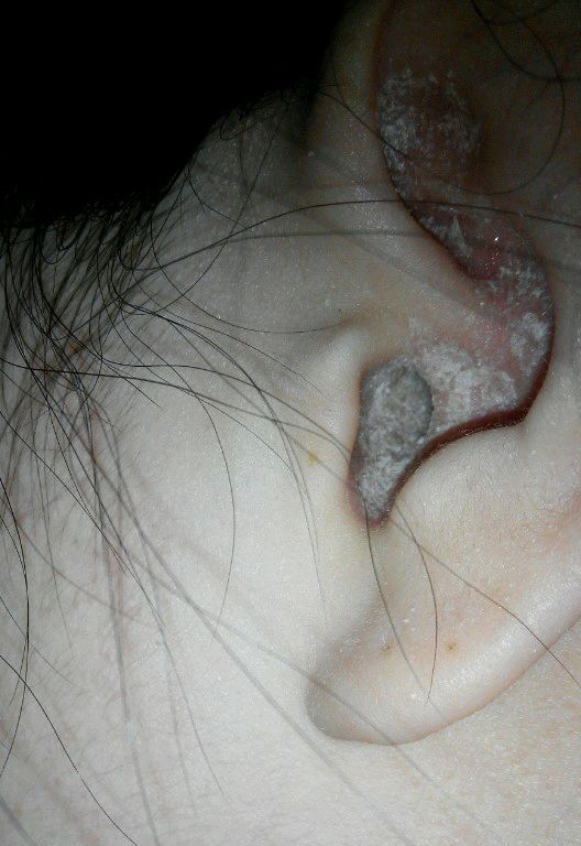 女性急性中耳炎流膿