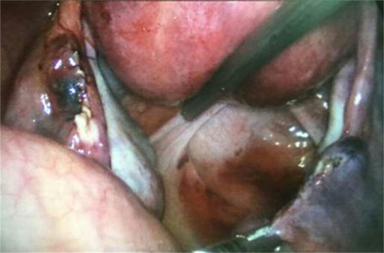 雙側輸卵管宮外孕