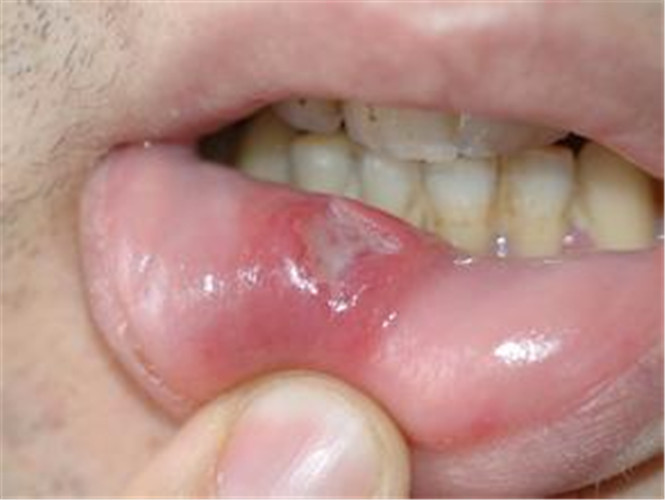 白塞病早期嘴唇