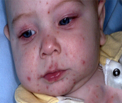 嬰兒蕁麻疹 (48) 