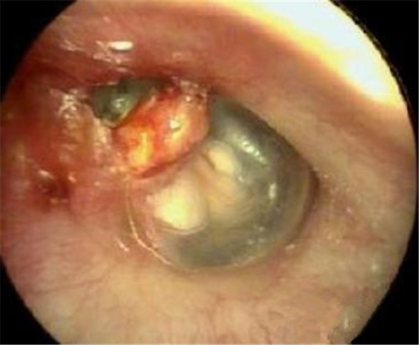 中耳炎鼓膜穿孔