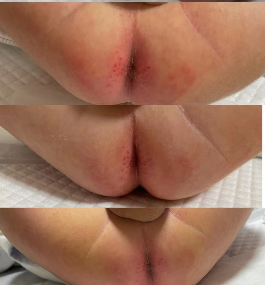 母乳性腹瀉臀部護理