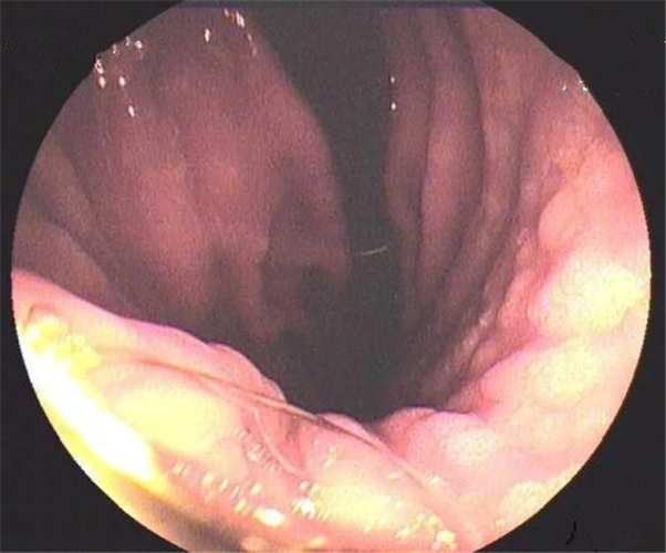 淺表型慢性胃炎好